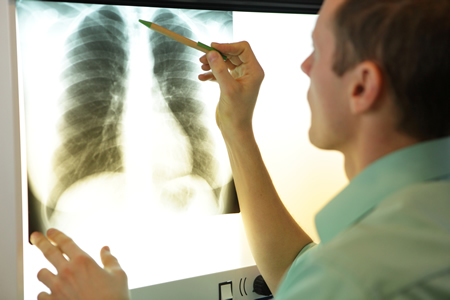 chest-xray-mesothelioma